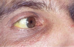 Liver Disease - Jaundice | Medical Support System