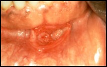 Cytomegalovirus