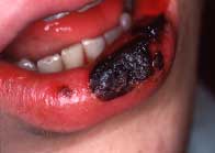 Hematologic Malignancy