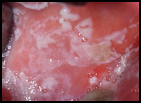 Herpes Viral Infection