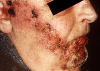 Herpes Zoster